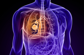 Aggressive Treatment For Some Stage Iv Lung Cancer Patients Can Dramatically Improve Overall Survival American Society For Radiation Oncology Astro American Society For Radiation Oncology Astro