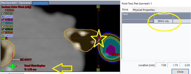 Figure 1: Plan sum dose cloud display, showing the TrachBronchTree contour extending into the 3900 cGy dose cloud, but a reported maximum dose of less than 3900 cGy