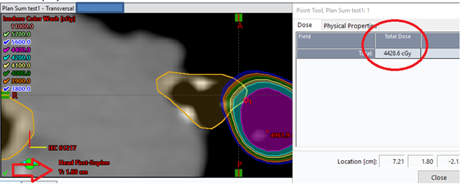 Figure 2: Plan sum dose cloud display, showing the TrachBronchTree contour extending into the 4200 cGy dose cloud, but a reported maximum dose of greater than 4400 cGy